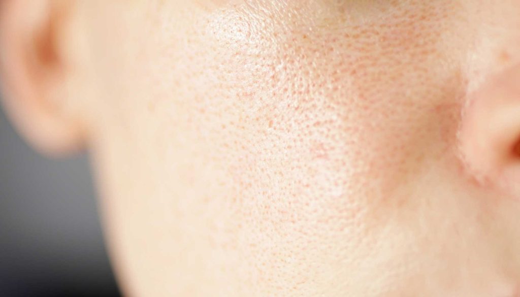 pores dilatés visage